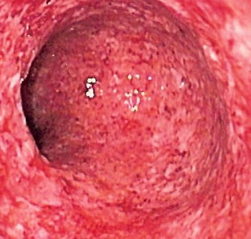 Aktive Colitis Crohn